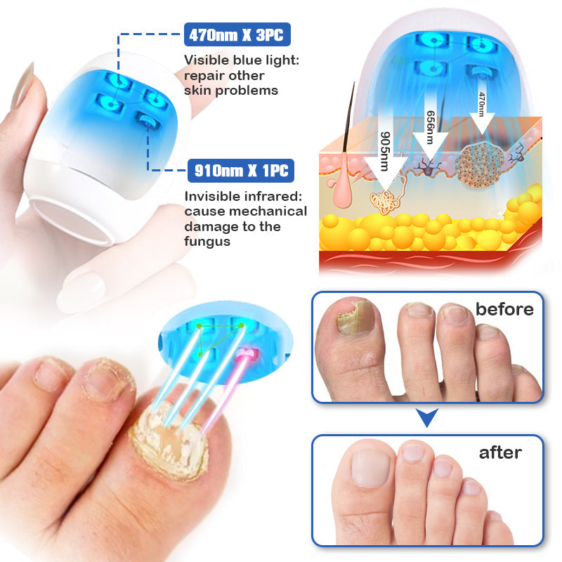 Amazon.com : Nail Fungus Laser Treatment Device,Onychom Laser Nail Treatment ,Nail Fungus Treatment for Toenails,Targets Damaged, Discolored and  Thickened Toenails : Health & Household